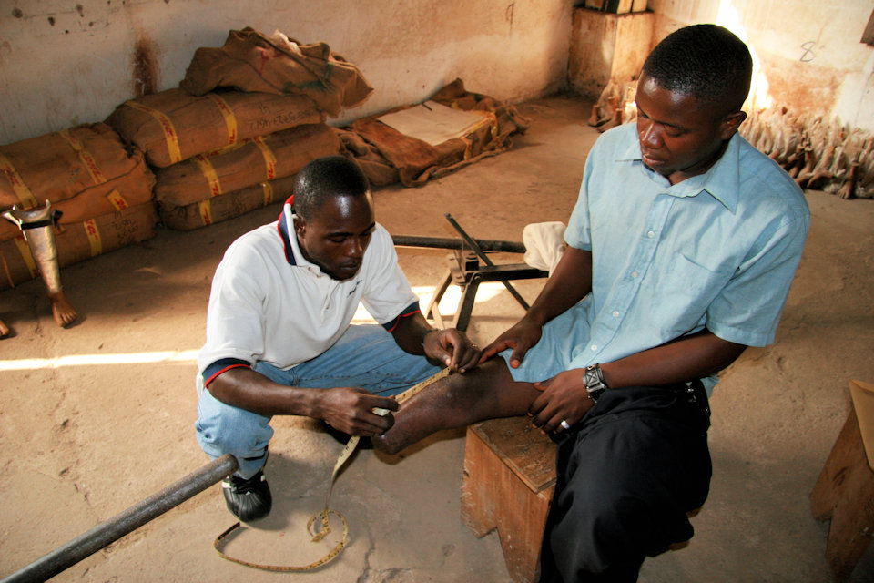 Man fitted for prosthetic leg